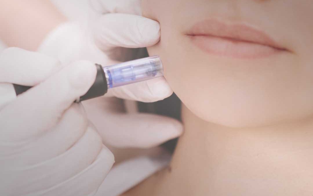 Il needling